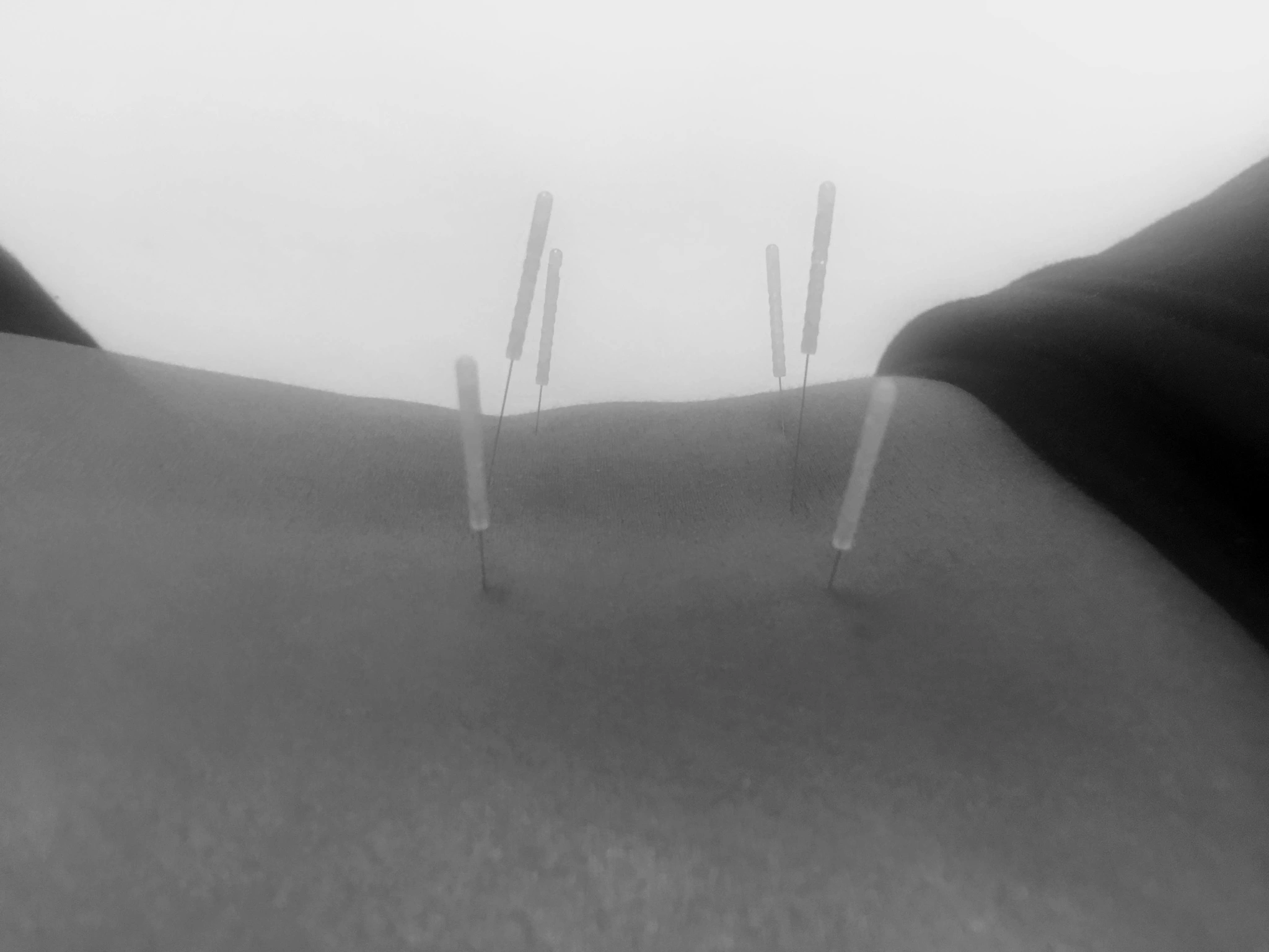 acupuncture